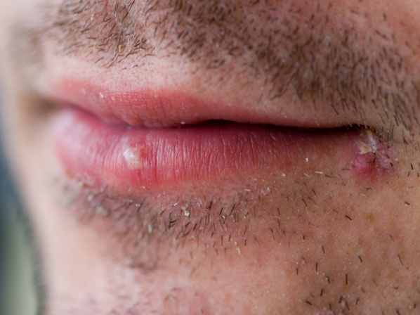 9 enfermedades trasmitidas por besos - 5. Herpes